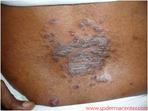 Psoriasis-Before